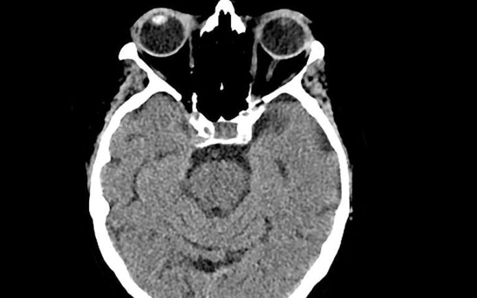 Teknologi Ini Prediksi Alzheimer dengan Akurasi Hampir 100 Persen